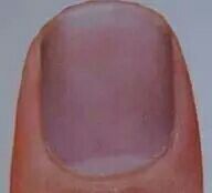 指甲上有竖纹，是身体有大病的征兆吗