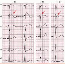 心脏V2、V3、V4导联ST段抬高所代表的意义